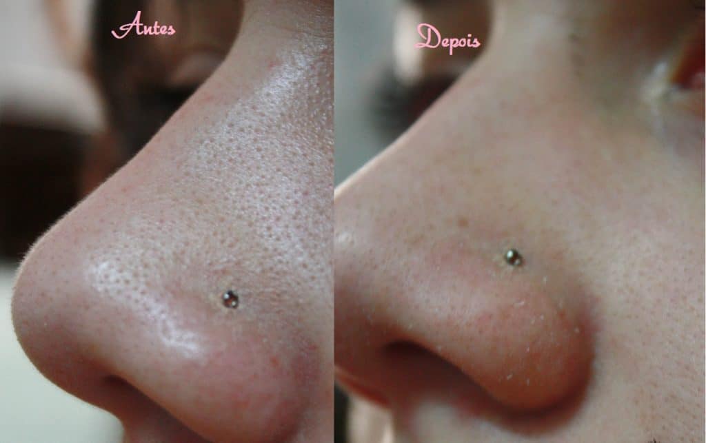 antes e depois limpeza de pele profunda nariz